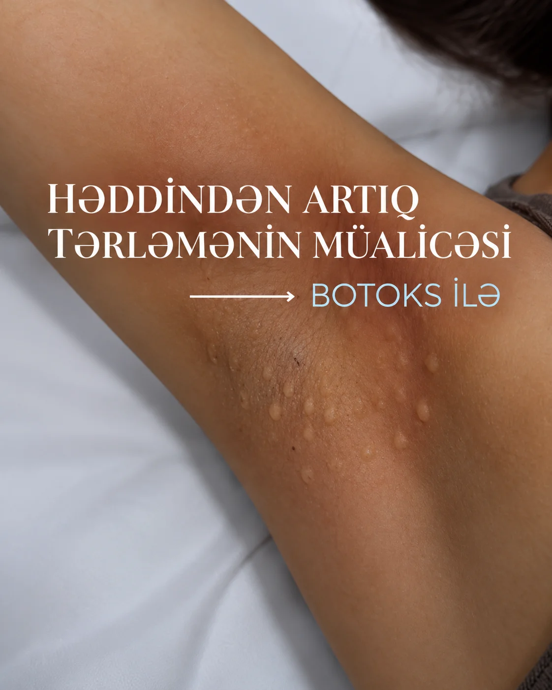 Heddinden artiq terlemeye botoksla nezaret!